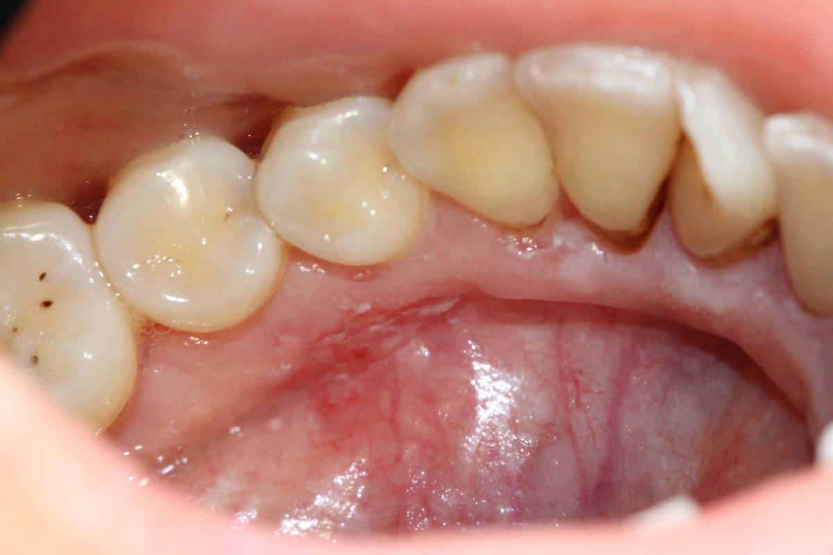 Localized Gingival Erythroleukoplakia In A 57 Year Old Fanconi Anemia