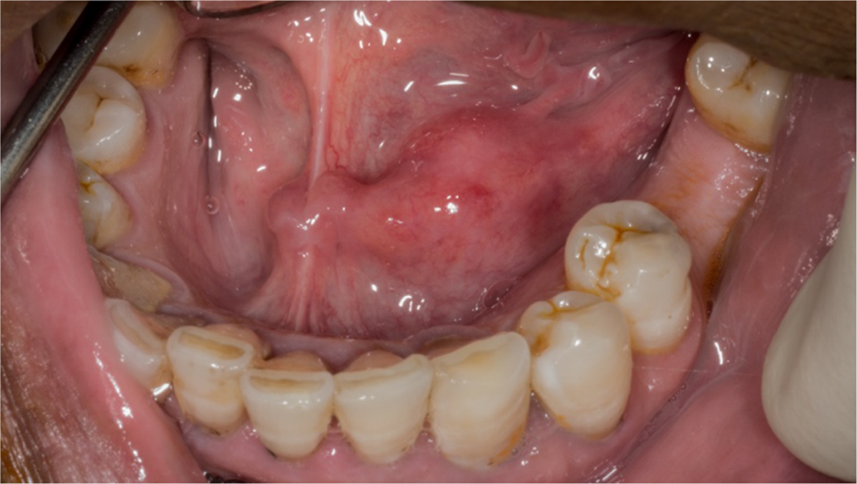 Management Of Anterior Submandibular Sialolithiasis Journal Of Oral