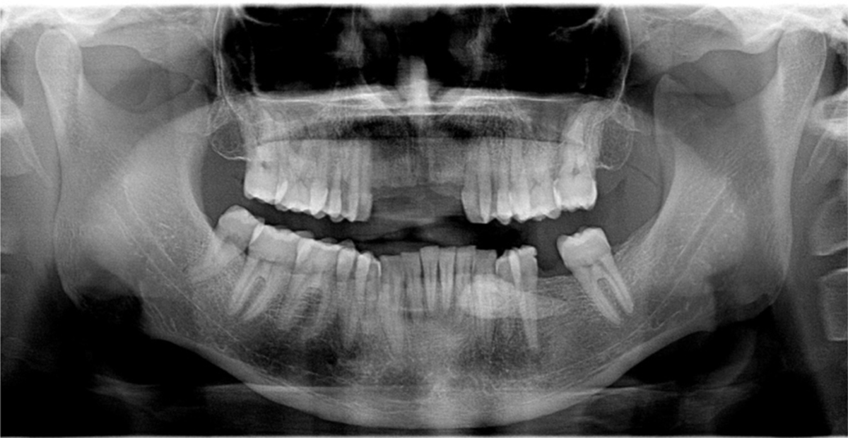 Management Of Anterior Submandibular Sialolithiasis Journal Of Oral